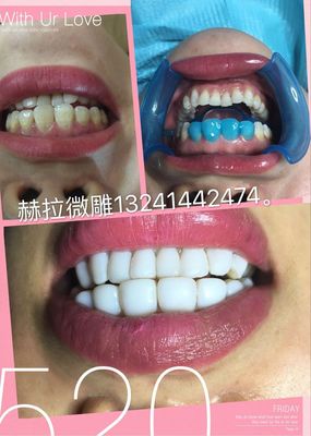 济南牙齿美容,纳米炫齿浮雕培训
