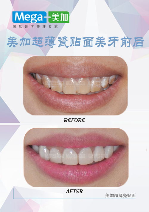 牙齿美白的速效 面膜