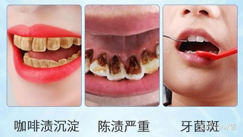 哪种牙膏比较美白