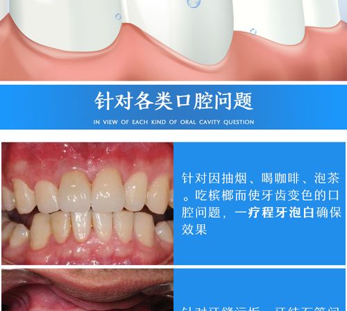 洁牙慕斯美白牙齿清新口气脱色剂牙洗牙粉美白神器