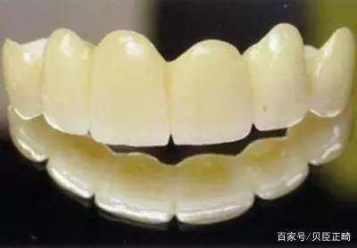 牙齿美容冠适合哪些人群,有哪些注意事项?