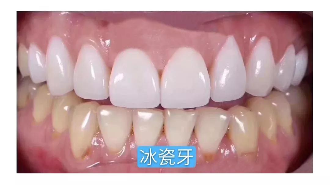 明星都是一口闪亮的大白牙,深受欢迎的"牙贴面"到底是什么神器