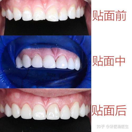 深圳美白牙贴面 牙齿贴面修复案例分享