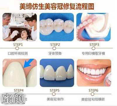 美容冠